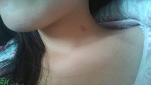 種草莓吻痕是什么意思？吻痕是怎么弄出來的？