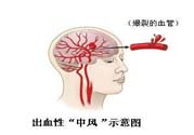 腦中風的發病因素？腦中風的并發癥有哪些 ？