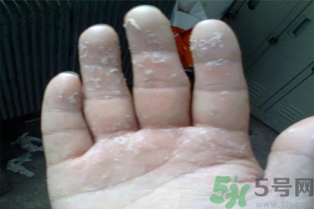 手足癬的易發人群有哪些？如何預防手足癬？
