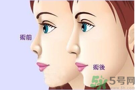玻尿酸隆鼻和手術隆鼻的區別是什么？