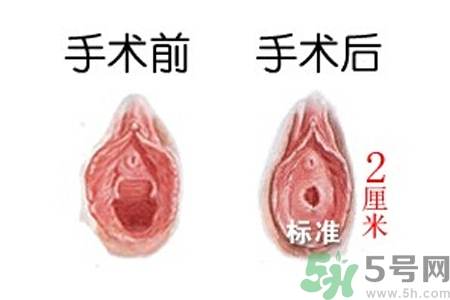 什么人不能做處女膜修補術？處女膜修補術會留疤嗎？