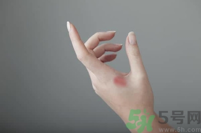 手被燙紅了怎么辦？手被燙了怎么止痛？