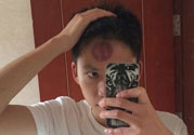 頭痛可以在額頭上拔火罐嗎？額頭上拔火罐有什么好處？