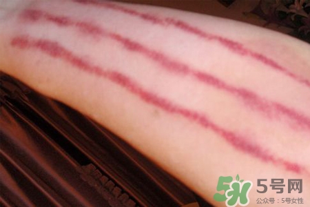 揪痧和刮痧哪個效果比較好？揪痧和刮痧的區(qū)別？