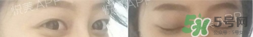 埋線雙眼皮多久恢復自然？埋線雙眼皮多久能恢復