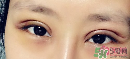 切開雙眼皮多久消腫？切開雙眼皮多久恢復？