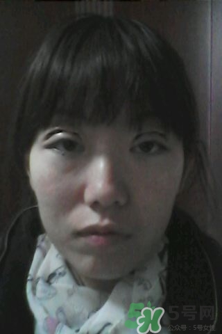 什么是定點雙眼皮？定點雙眼皮多少錢？