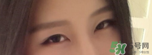 切開雙眼皮多久消腫？切開雙眼皮多久恢復？
