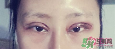 切開雙眼皮多久消腫？切開雙眼皮多久恢復？
