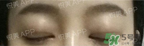 埋線雙眼皮多久恢復自然？埋線雙眼皮多久能恢復