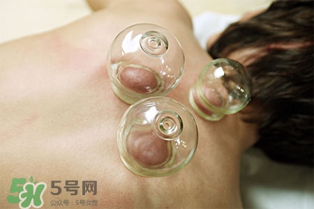 拔罐放血會得傳染病么？拔罐放血會傳染疾病嗎？