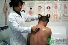 刮痧可以去濕氣嗎？體內濕氣重刮痧有用嗎？