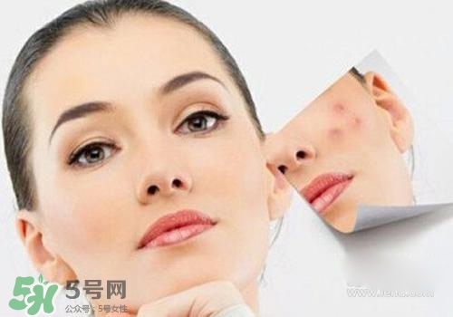 封閉性粉刺會自己消失嗎？封閉性粉刺好了會留疤嗎？