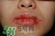 嘴唇干燥是什么原因？嘴唇干裂脫皮怎么辦？