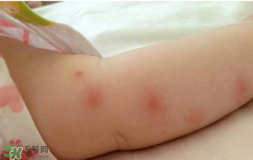 嬰兒蚊子咬了怎么消腫？嬰兒蚊子咬了怎么消腫止癢最快？