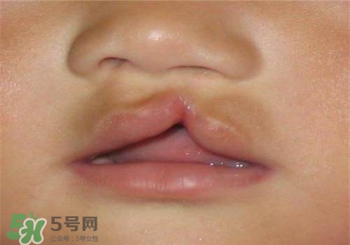 兔唇能檢查出來嗎？兔唇能完全修復嗎？