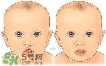 兔唇能檢查出來嗎？兔唇能完全修復嗎？