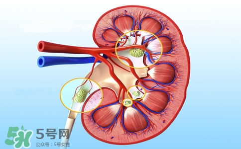 腎結石有什么癥狀？腎結石原因