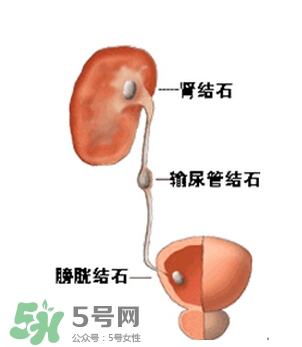 腎結石有什么癥狀？腎結石原因