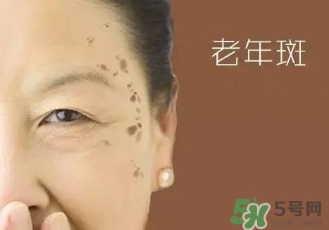 老年斑多大年齡開始有？為什么牙膏能去老年斑？