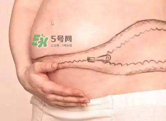 剖腹產(chǎn)疤痕怎么去除？剖腹產(chǎn)疤痕能去掉嗎？