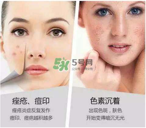 果酸換膚自己可以做嗎？果酸換膚后注意事項