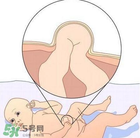 臍疝是什么？臍疝對寶寶有什么影響？