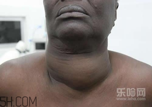 甲狀腺腫大和甲亢的區別有哪些？甲狀腺腫大適合吃什么食物？