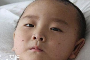 痣什么情況下會轉變為瘤？點痣不可取