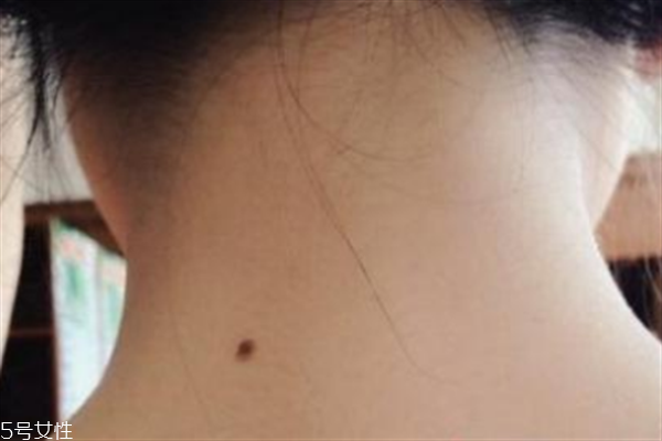 脖子后面有痣好嗎？激光冷凍祛痣易導致癌變
