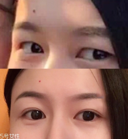 內雙怎么進化成雙眼皮？全是雙眼皮貼的功勞
