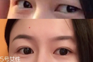 內雙怎么進化成雙眼皮？全是雙眼皮貼的功勞