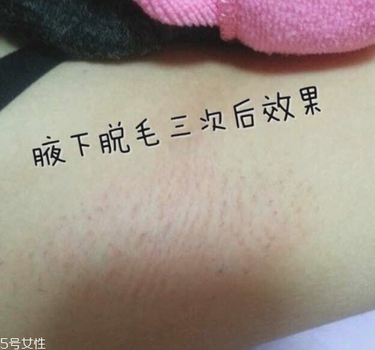 雅萌脫毛儀閃燈次數是多少 雅萌脫毛儀的使用壽命