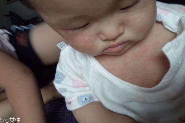 幼兒急疹和感冒發燒的區別 幼兒急疹的臨床癥狀