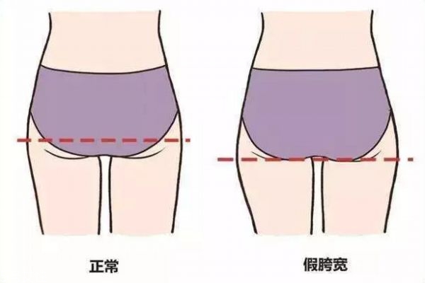 假胯寬可以用收胯帶嗎 真胯寬和假胯寬的區別