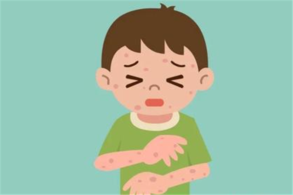 蕁麻疹中醫能治好嗎 蕁麻疹中醫調理需要多長時間好