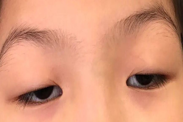 武漢上眼瞼下垂哪個醫院做的好 武漢上眼瞼下垂修復手術要多少錢